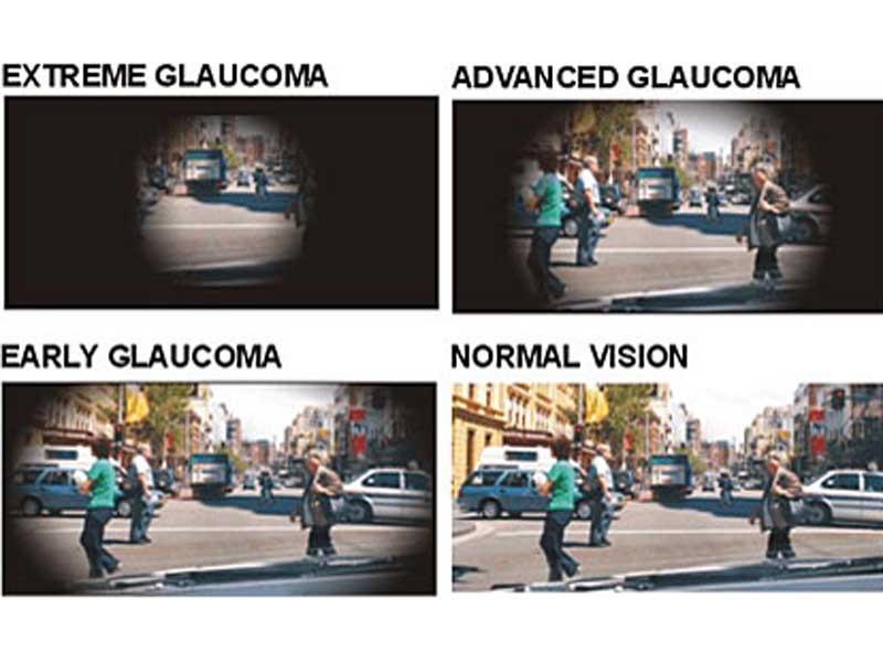 Psicotécnicos: El glaucoma, un riesgo para la conducción